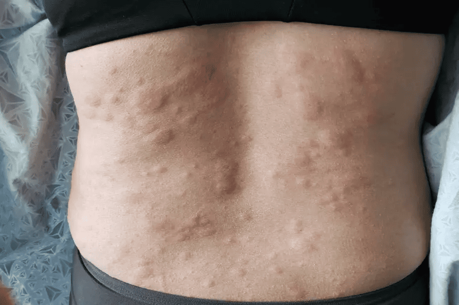 Anaphylaxis: Current Insights into Diagnosis and Management for Emergency Clinicians