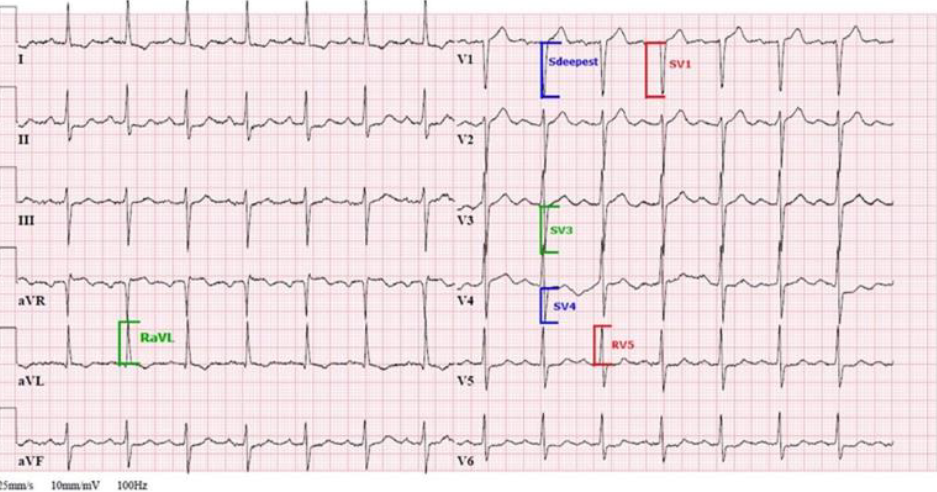 Pulse Pressure Related to Type 4 Cardiorenal Syndrome and Peguero – Lo Presti Positive Index in Patients with Chronic Kidney Disease Stage G5.