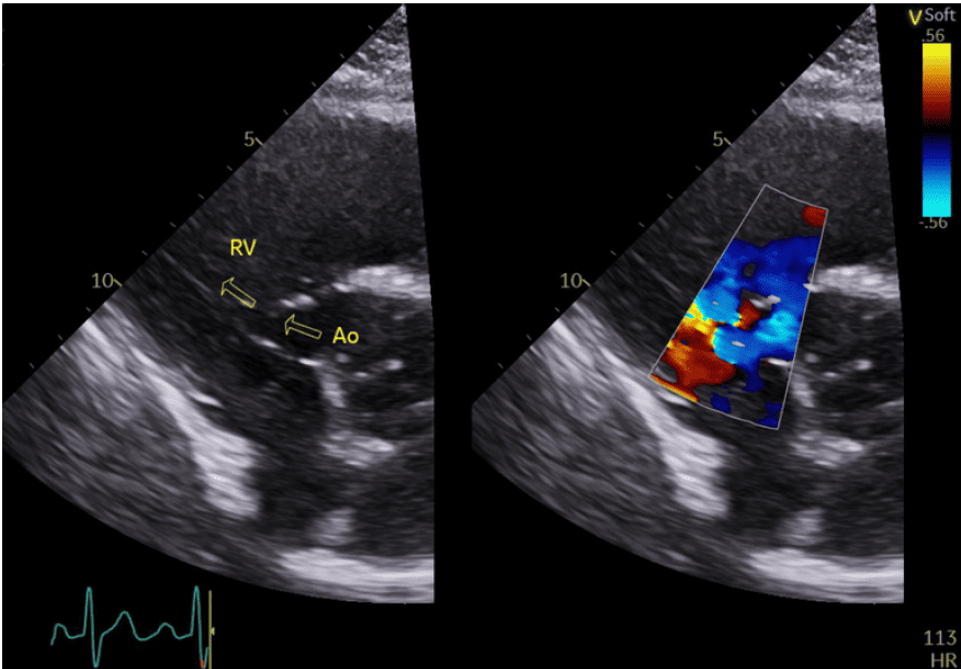 Ruptured Sinus of Valsalva: Curious Case of Transient Loss of Consciousness