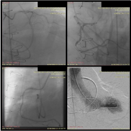 Interventional management of acute myocardial infarction type 5. Case presentation and literature review