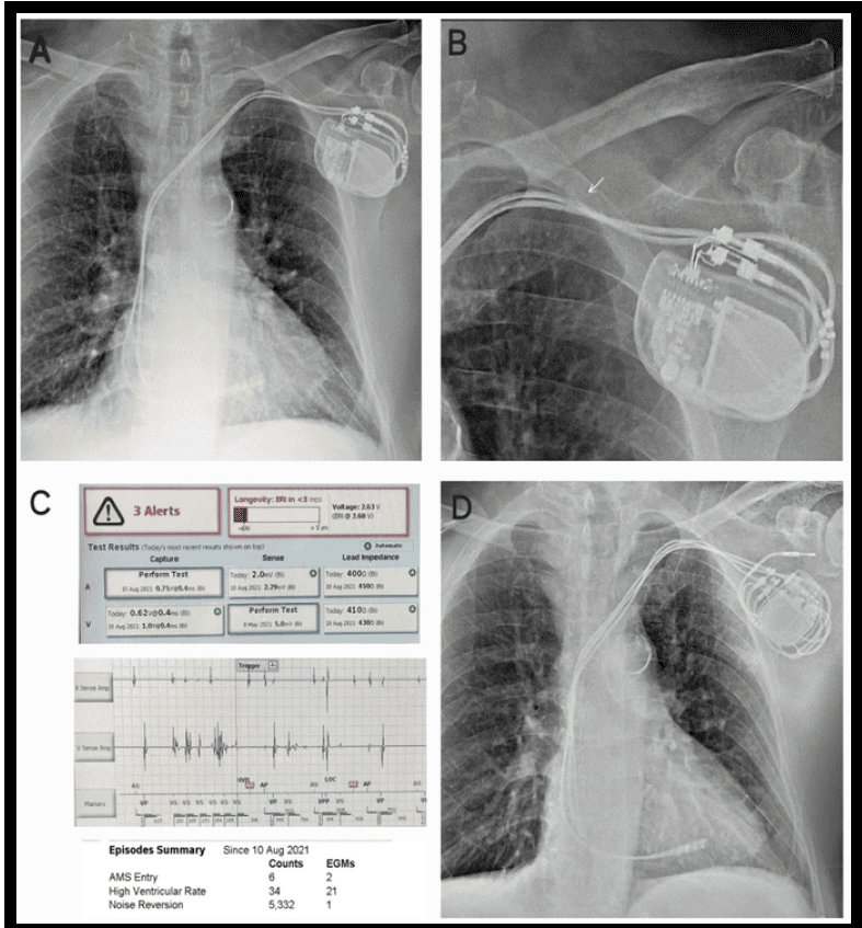 Late lead failure in cardiac implantable electronic devices: “Catastrophic if missed”