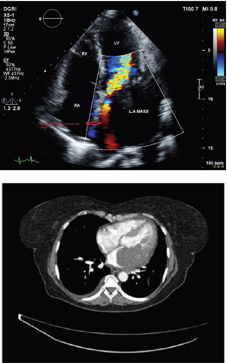 An Interesting Differential for Orthopnoea: Leiomyosarcomas