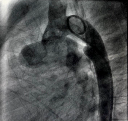 Transcatheter Closure of Patent Ductus Arteriosus with Pulmonary Arterial Hypertension of Down Syndrome Children: Case Reports