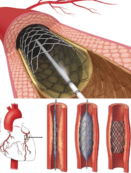 Syntax Residual Como Predictor De Efectos Adversos Post Angioplastia Percutanea, Seguimiento a 3 Años