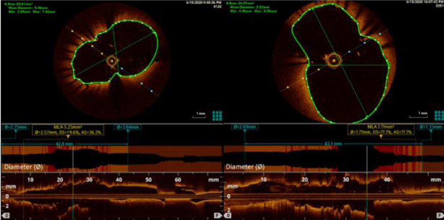 Post-PCI LAD aneurysm in a SARS-CoV-2 IgG positive patient
