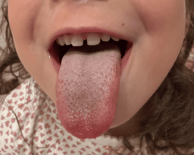 Kawasaki disease with COVID-19 positive children, evaluation of multi-system inflammatory syndrome in children (MIS-C): A Case Study