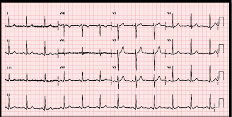 Complications of subarachnoid hemorrhage on the heart