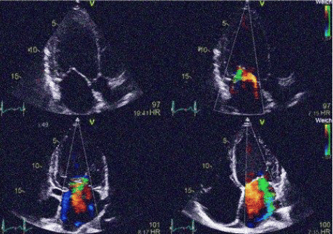 Khat associated cvs complications: A case report of Ethiopian male