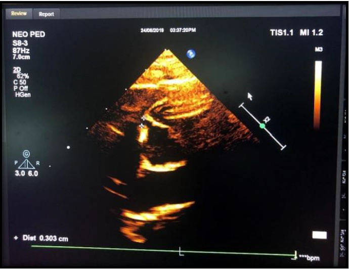 Re-dilation of Coronary Arteries of a Child with H/O Atypical Kawasaki Disease, following Chickenpox: A Case Study