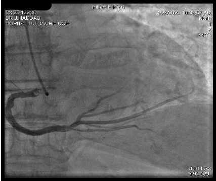 Anomalous Origin of Left Coronary Artery from Right Sinus of Valsalva: A Case Report