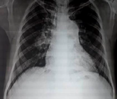 An unusual presentation of chronic eosinophilic leukemia as pulmonary arterial hypertension- A Case Report