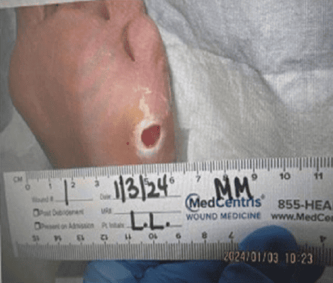 Spontaneous femoral artery dissection: A case report