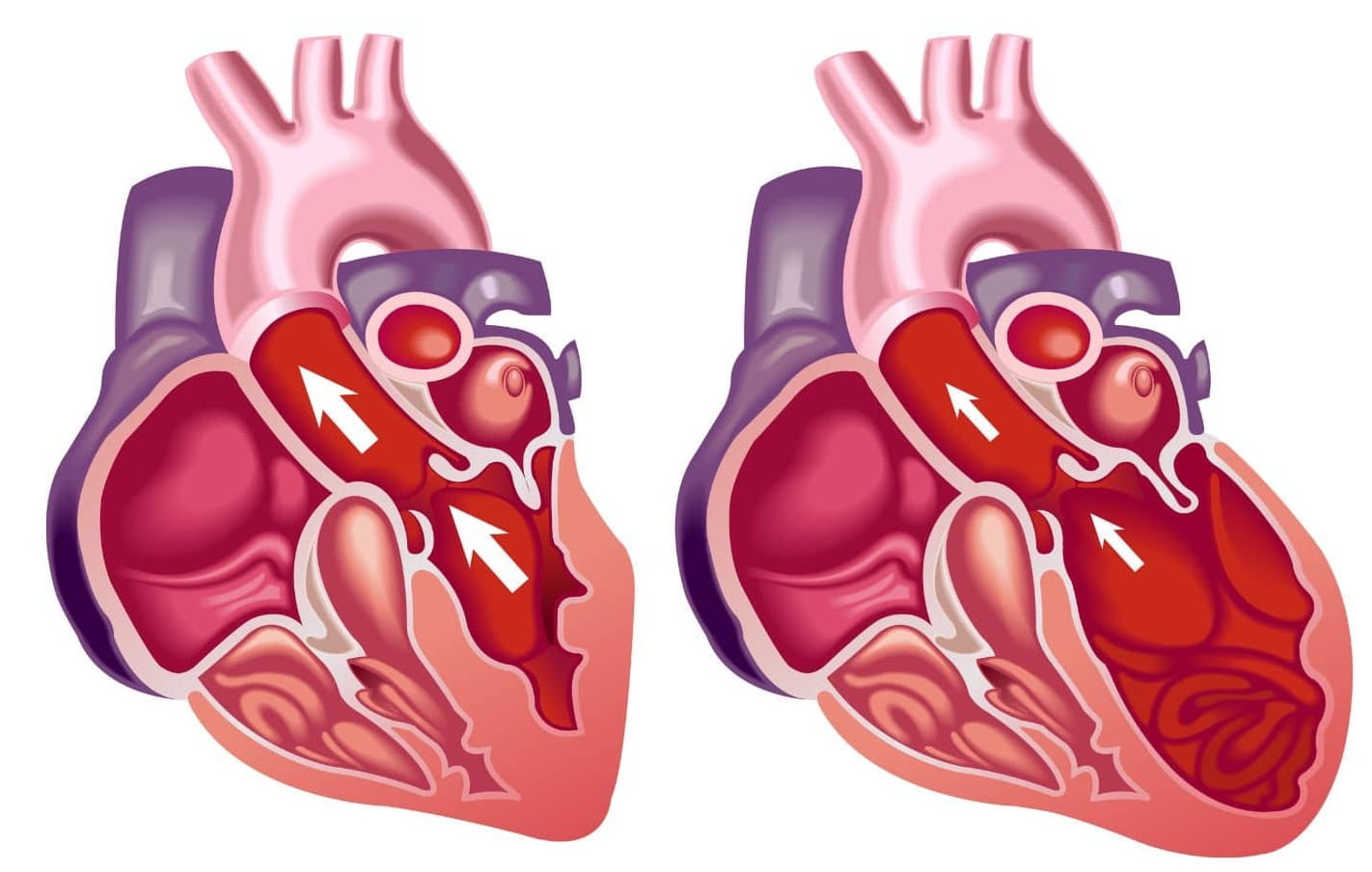 Reversibility of Dilated Cardiomyopathy in a child with Sepsis