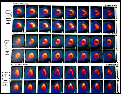 Resolving asymptomatic Triple Vessel coronary artery disease with Coronary artery bypass grafting in diabetic patients