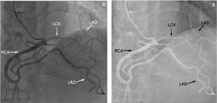 Case report of single coronary artery subtype (R-IIA) in a female patient, with cerebral hemorrhage, its evaluation, and life expectancy